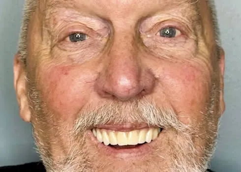 Jim smiling with new teeth after full-arch dental implants